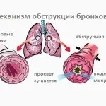 Як лікувати бронхіт у дитини в домашніх умовах народними засобами (дитини) Як лікувати бронхіт у дитини в домашніх умовах народними засобами