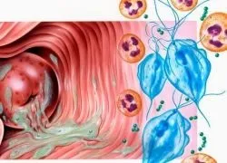 Як лікувати кольпіт
