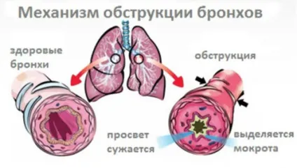 Як лікувати бронхіт у дітей в домашніх умовах (бронхіт) Як лікувати бронхіт у дітей в домашніх умовах