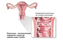 Як полегшити симптоми молочниці в домашніх умовах 1 (домашніх) Як полегшити симптоми молочниці в домашніх умовах 1