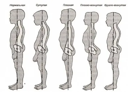 Як плаванням виправити порушення постави (м'язів грудної клітки) Як плаванням виправити порушення постави
