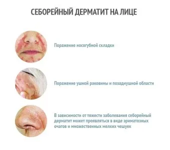 Як розпізнати лікувати себорейний дерматит на обличчі (Потім засіб залишається) Як розпізнати лікувати себорейний дерматит на обличчі