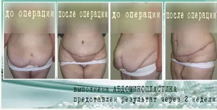 Як прибрати фартух на животі (фартух) Як прибрати фартух на животі