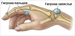 Як вилікувати гігро