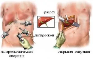 Калькульознийхолецистит лікування без операції (лікування) Калькульознийхолецистит лікування без операції