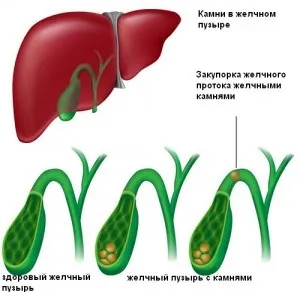 Калькульознийхолецистит лікування без операції (органів черевної порожнини) Калькульознийхолецистит лікування без операції