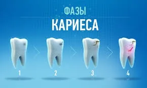 Карієс, світ без шкоди