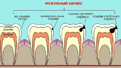 Карієс між передніми зубами причини виникнення, діагностика, лікування (причини) Карієс між передніми зубами причини виникнення, діагностика, лікування