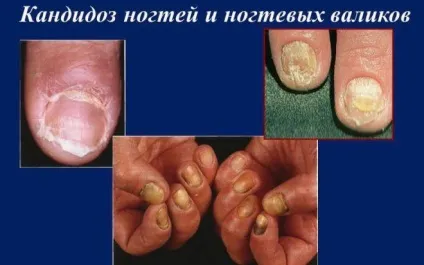 Кандидоз нігтів (грибок) і шкіри лікування (грибок) Кандидоз нігтів (грибок) і шкіри лікування