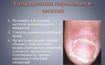 Кандидоз нігтів (грибок) і шкіри лікування (кандидоз) Кандидоз нігтів (грибок) і шкіри лікування