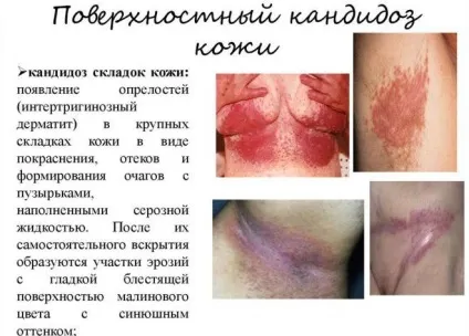 Кандидоз нігтів (грибок) і шкіри лікування (кандидоз) Кандидоз нігтів (грибок) і шкіри лікування