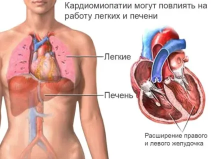 Кардиопатия симптоми і ознаки первинної і вторинної форм, а також класифікація та лікування (ознаки) Кардиопатия симптоми і ознаки первинної і вторинної форм, а також класифікація та лікування