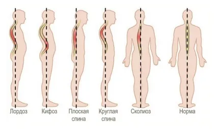 Кіфосколіоз грудного відділу хребта що це, форми, ознаки (відділу) Кіфосколіоз грудного відділу хребта що це, форми, ознаки