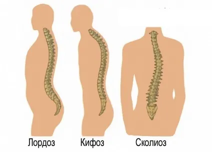 Кіфоз, лордоз і сколіоз - в чому відмінність хвороб
