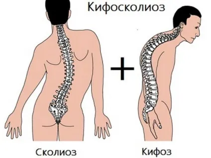 Кіфосколіоз грудного відділу хребта що це, форми, ознаки (кіфосколіоз) Кіфосколіоз грудного відділу хребта що це, форми, ознаки