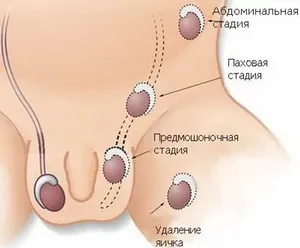 Коли (у скільки років) у хлопчиків опускаються яєчка - вік, патології та лікування, чому ні (коли у дитини опускаються яєчка) Коли (у скільки років) у хлопчиків опускаються яєчка - вік, патології та лікування, чому не