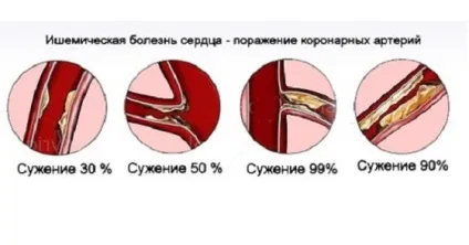 Коли призначаються блокатори кальцієвих каналів і як їх приймати (каналів) Коли призначаються блокатори кальцієвих каналів і як їх приймати