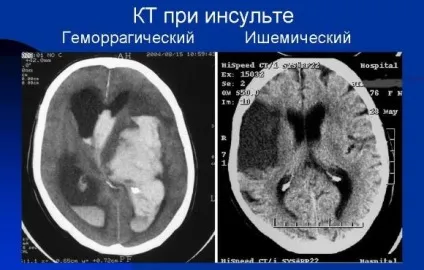 Комп'ютерна томографія (кт) при інсульті головного мозку (мозку) Комп'ютерна томографія (кт) при інсульті головного мозку