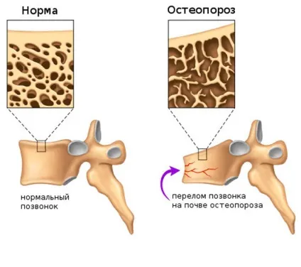 Компресійний перелом хребта у літніх симптоми і лікування (хребта) Компресійний перелом хребта у літніх симптоми і лікування