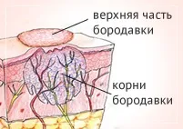Коріння бородавок фото, як виглядає корінь бородавки (коріння) Коріння бородавок фото, як виглядає корінь бородавки