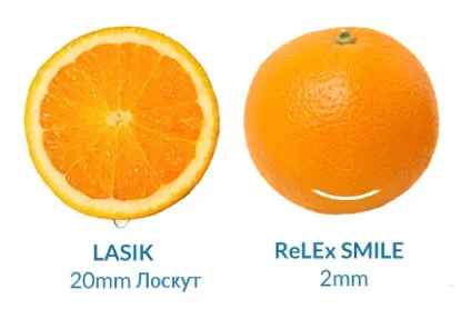 Корекція зору relex smile вся правда про ускладнення смайл