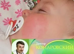 Червоні щоки у дитини, причини