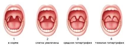 Червоне горло у дитини фото, відео та рекомендації щодо лікування (червоне) Червоне горло у дитини фото, відео та рекомендації щодо лікування
