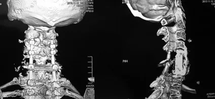 Кт хребта - сучасний метод діагностики (діагностики) Кт хребта - сучасний метод діагностики