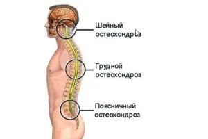 Лікування остеохондрозу грудного відділу хребта ліки, масаж, ЛФК (остеохондроз грудного відділу хребта лікування) Лікування остеохондрозу грудного відділу хребта ліки, масаж, ЛФК