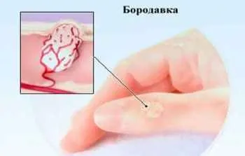 Лікування бородавок народними методами (народними) Лікування бородавок народними методами