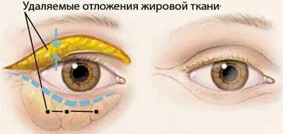 Лазерна блефаропластика верхніх і нижніх повік (лазерна) Лазерна блефаропластика верхніх і нижніх повік