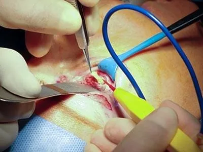Лазерна блефаропластика верхніх і нижніх повік (лазерна) Лазерна блефаропластика верхніх і нижніх повік