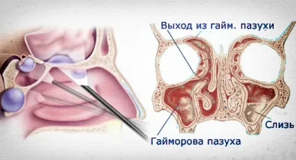 Лікування кісти носа народними засобами (засобами) Лікування кісти носа народними засобами