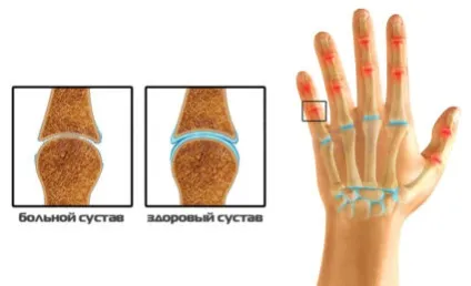 Лікування артрозу дрібних суглобів кистей рук і профілактика недуги (лікування) Лікування артрозу дрібних суглобів кистей рук і профілактика недуги