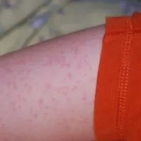 Лікування рожевого лишаю у людини в домашніх умовах, препарати та народні засоби (лікування) Лікування рожевого лишаю у людини в домашніх умовах, препарати та народні засоби