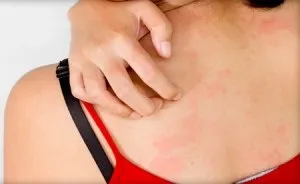 Лікування рожевого лишаю у людини в домашніх умовах, препарати та народні засоби (лікування) Лікування рожевого лишаю у людини в домашніх умовах, препарати та народні засоби