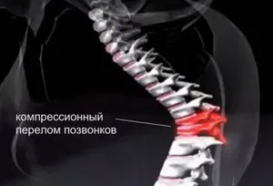 Лікування у літніх людей компресійного перелому хребта причини і діагностика, лікування і (лікування компресійний перелом хребта літня людина) Лікування у літніх людей компресійного перелому хребта причини і діагностика, лікування та