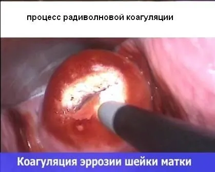 Лікування захворювань шийки матки фонових і передракових (шийки) Лікування захворювань шийки матки фонових і передракових