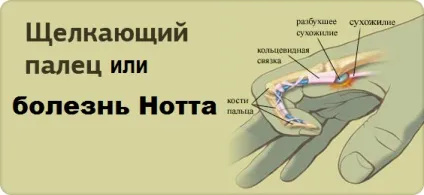 Лігаментит пальця лікування хвороба Нотта метод Шастіна відгуки