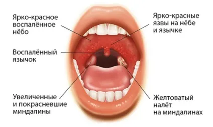 Лікуємо кашель у дитини в домашніх умовах народними засобами (дитини) Лікуємо кашель у дитини в домашніх умовах народними засобами
