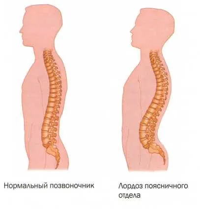 Лордоз, кіфоз і сколіоз причини, симптоми, лікування, meddoc (кіфоз) Лордоз, кіфоз і сколіоз причини, симптоми, лікування, meddoc