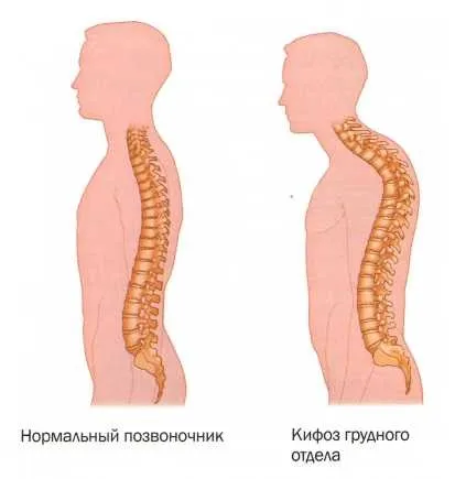 Лордоз, кіфоз і сколіоз причини, симптоми, лікування, meddoc (кіфоз) Лордоз, кіфоз і сколіоз причини, симптоми, лікування, meddoc