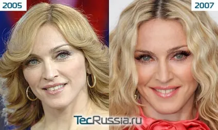 Мадонна - фото до і після пластичних операцій (операцій) Мадонна - фото до і після пластичних операцій
