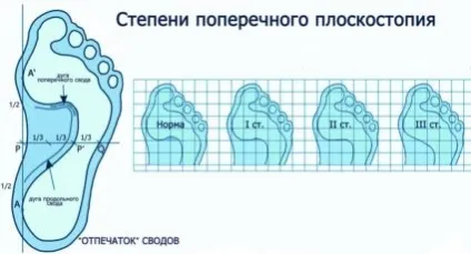 Поперечна плоскостопість; методи лікування, діагностика, симптоми (біль) Поперечна плоскостопість; методи лікування, діагностика, симптоми