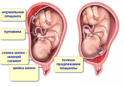 Поперечний передлежання плода причини виникнення, викликані ускладнення при пологах, вправи для (причини) Поперечний передлежання плода причини виникнення, викликані ускладнення при пологах, вправи для