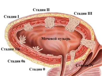 Поліпи в сечовому міхурі у чоловіків які симптоми і лікування (міхурі) Поліпи в сечовому міхурі у чоловіків які симптоми і лікування