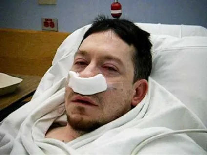 Поліпи в носі лікування без операції (носі народними засобами) Поліпи в носі лікування без операції
