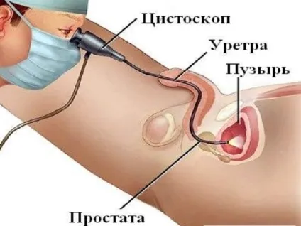 Поліпи в сечовому міхурі у чоловіків які симптоми і лікування (поліпи) Поліпи в сечовому міхурі у чоловіків які симптоми і лікування