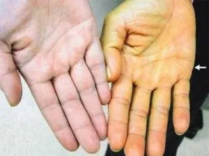 Механічна жовтяниця і її лікування народними засобами (механічна) Механічна жовтяниця і її лікування народними засобами