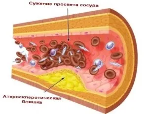 Методи лікування судин головного мозку (методи) Методи лікування судин головного мозку